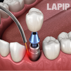 LAPIP Laser Periodontal Treatment